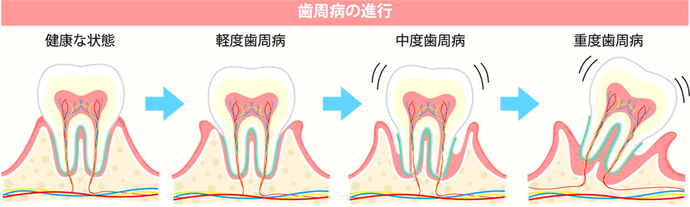 歯周病