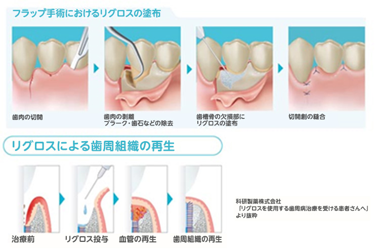 リグロスの治療方法