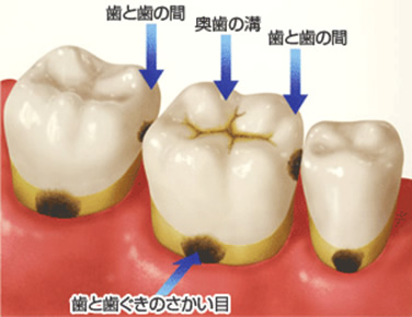 虫歯